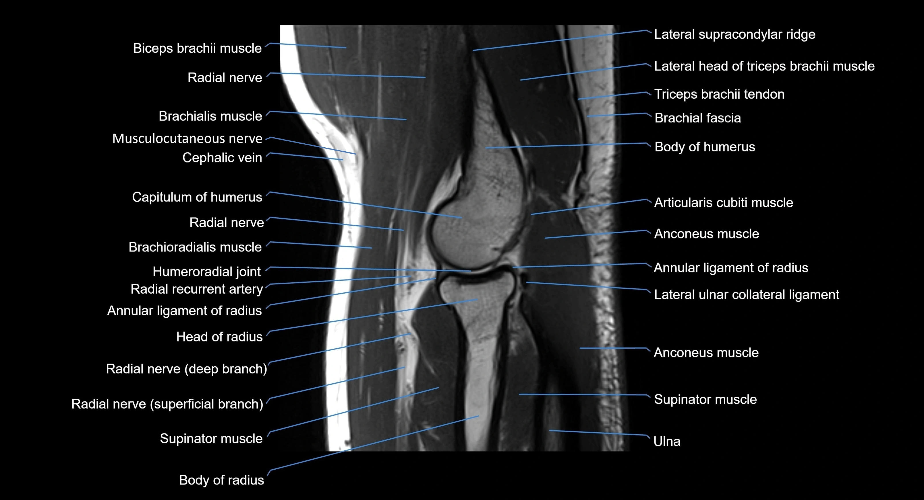 MRI elbow joint  sagittal cross sectional anatomy 3T  radiology  image-img-00001-00017.webp